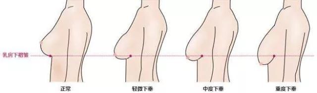 腋下副乳是怎么形成的腋下副乳怎么形成的原因