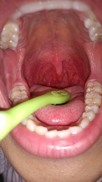 喉咙出现白色异物喉咙有异物感白色颗粒